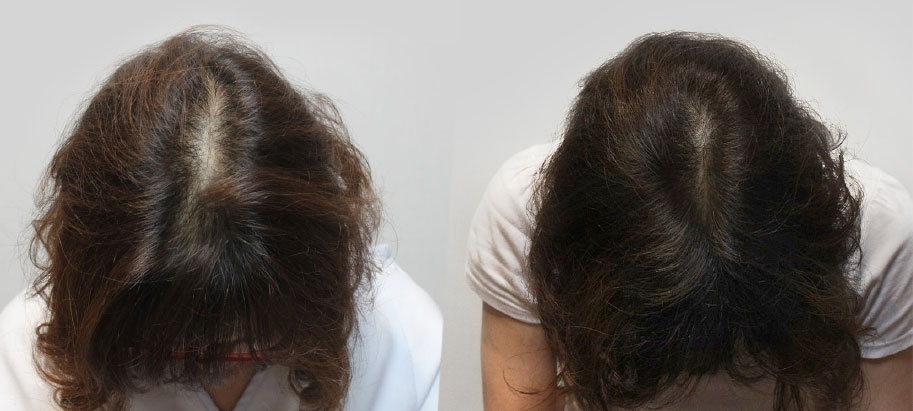 Hair loss Before / After Kerastem